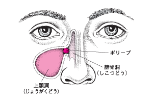 ＜副鼻腔炎の図＞