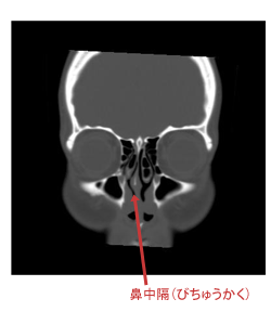 CT検査 前から見た図