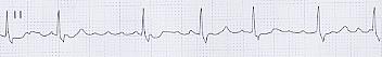心房細動の心電図