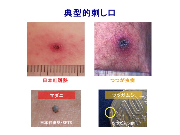 典型的刺し口