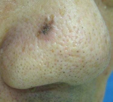 鼻の基底細胞癌