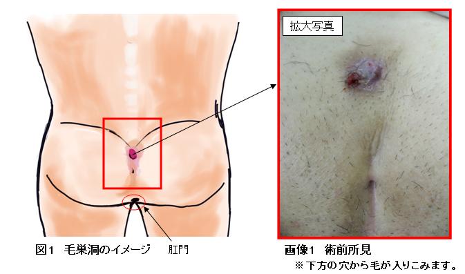 毛巣洞イメージ