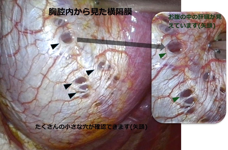 画像2 横隔膜の病変