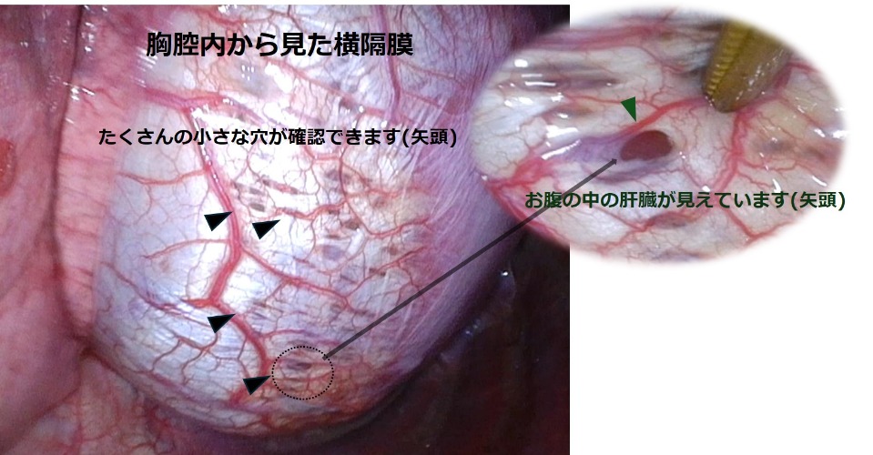 画像3 横隔膜の病変
