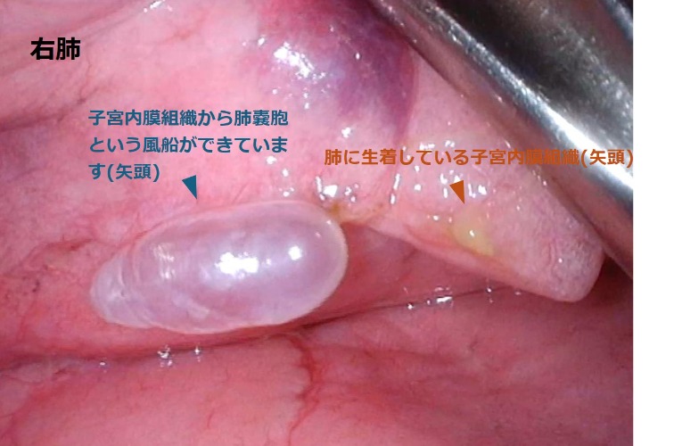 画像4 肺嚢胞と子宮内膜組織