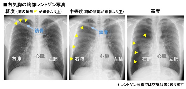 画像1 右気胸の胸部レントゲン写真