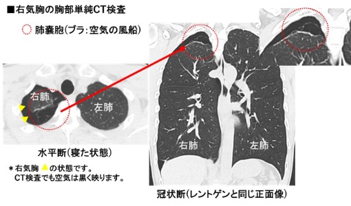 画像2 右気胸の胸部単純CT検査