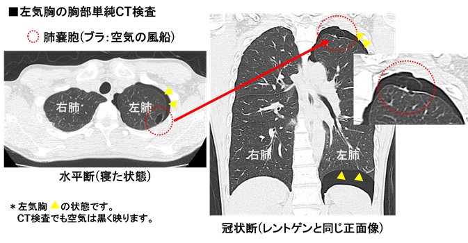 画像3 左気胸の胸部単純CT検査