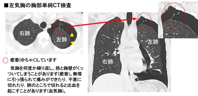 画像4 胸部単純CT検査