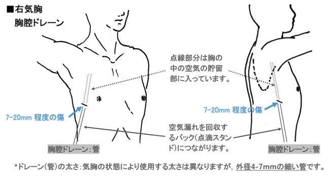 画像5 右気胸胸腔ドレーン