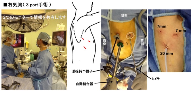 画像6 右気胸（３port手術）