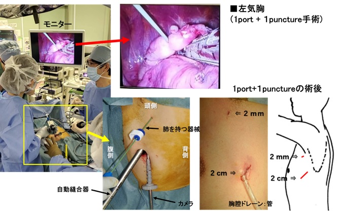 画像7 左気胸（1port＋1puncture手術）