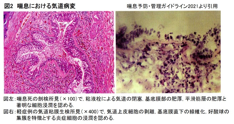 図１　気管支喘息 発病・増悪のメカニズム