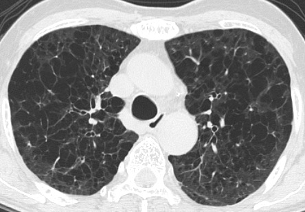 図2 胸部CT