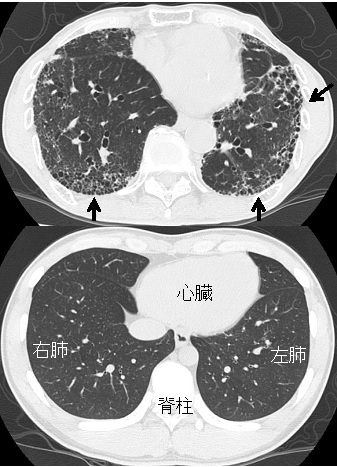 図表2 CT画像　上：「通常型」の間質性肺炎　下：正常