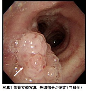 写真1 気管支鏡写真