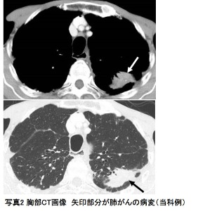写真2 胸部CT画像