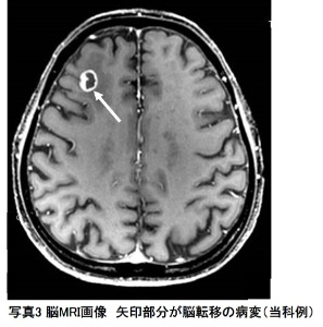 写真3 脳MRI画像