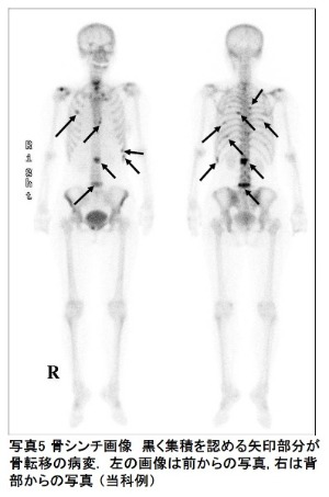写真5 骨シンチ画像