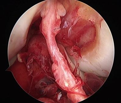 図2.ラグビーで受傷し完全に断裂したACL(受傷後1週の関節鏡所見)