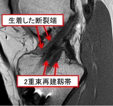 図7.レムナント温存解剖学的二重束再建術1年後のMRI像