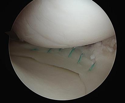 図9.内側半月縫合術術後の鏡視像