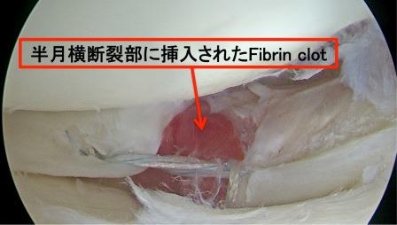 図10.Fibrin clotを用いた半月縫合後の鏡視像