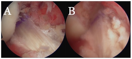 図8.ART－BTB ACL再建術の術後鏡視像。A前方外側より、B前方内側より鏡視（同一患者さんの再建靱帯）。Bでは再建靱帯走行にねじれがあることがわかる。