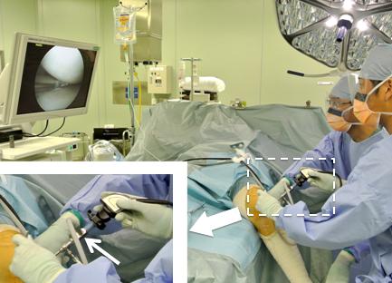 膝の半月板損傷の関節鏡手術