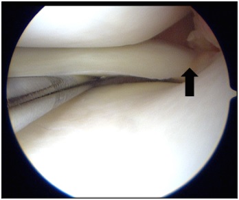 図1.正常な内側半月板後根(左ひざ関節鏡写真、矢印)
  