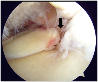図2.内側半月板後根断裂。完全に断裂している(左ひざ関節鏡写真、矢印)。  