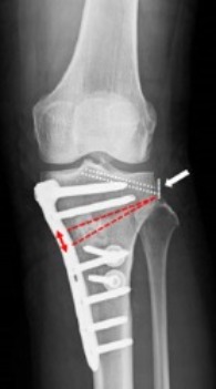 図6.内側半月後根損傷pullout修復と脛骨骨切り術の術後X線写真