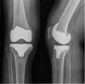 図5 人工膝関節置換術の術後レントゲン写真