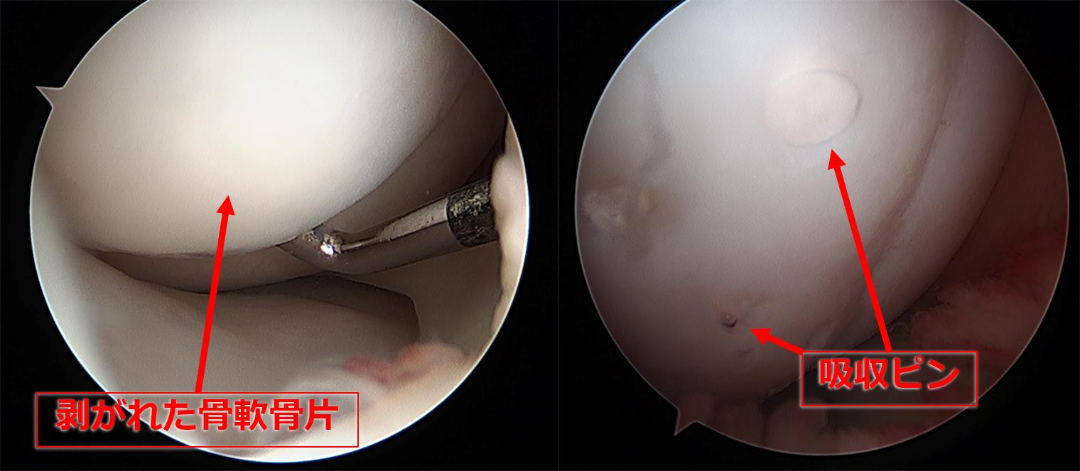 図3　骨軟骨片の整復内固定術直後の鏡視所見