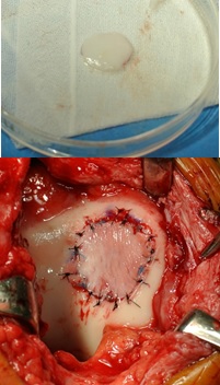 (上)図6再生関節軟骨（下）図7再生関節軟骨移植術の術直後