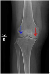 図1 変形性膝関節症の患者さんのX線画像
