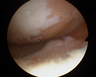図2 関節鏡写真、内側関節
