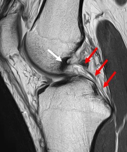 図3.陳旧性後十字靭帯断裂のMRI画像
