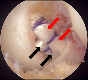 図5.大腿骨側移植腱の前内側からの関節鏡視像（左膝）
