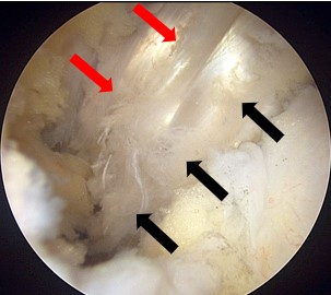 図6.脛骨側移植腱の後内側からの関節鏡視画像（左膝）