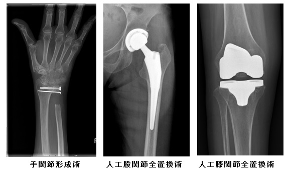 手関節形成術・人工股関節・膝関節全置換術