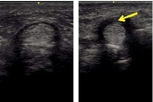 腱鞘と腱の超音波画像