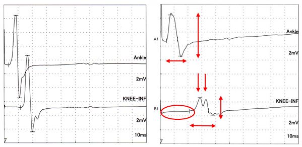 神経伝導検査の波形