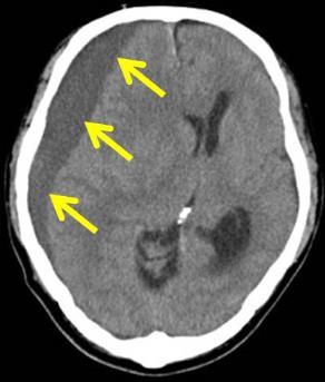 図1 慢性硬膜下血腫・水腫のCT画像