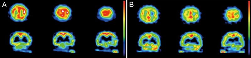 図2 特発性正常圧水頭症患者の脳血流SPECT画像