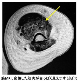 筋MRI