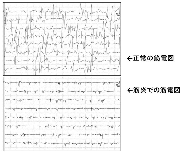  EMG は MS の診断に役立ちますか?