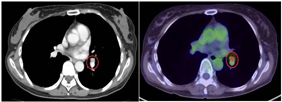 胸部造影CTとPET/CT画像