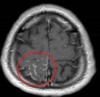 頭部MRI　FLAIR