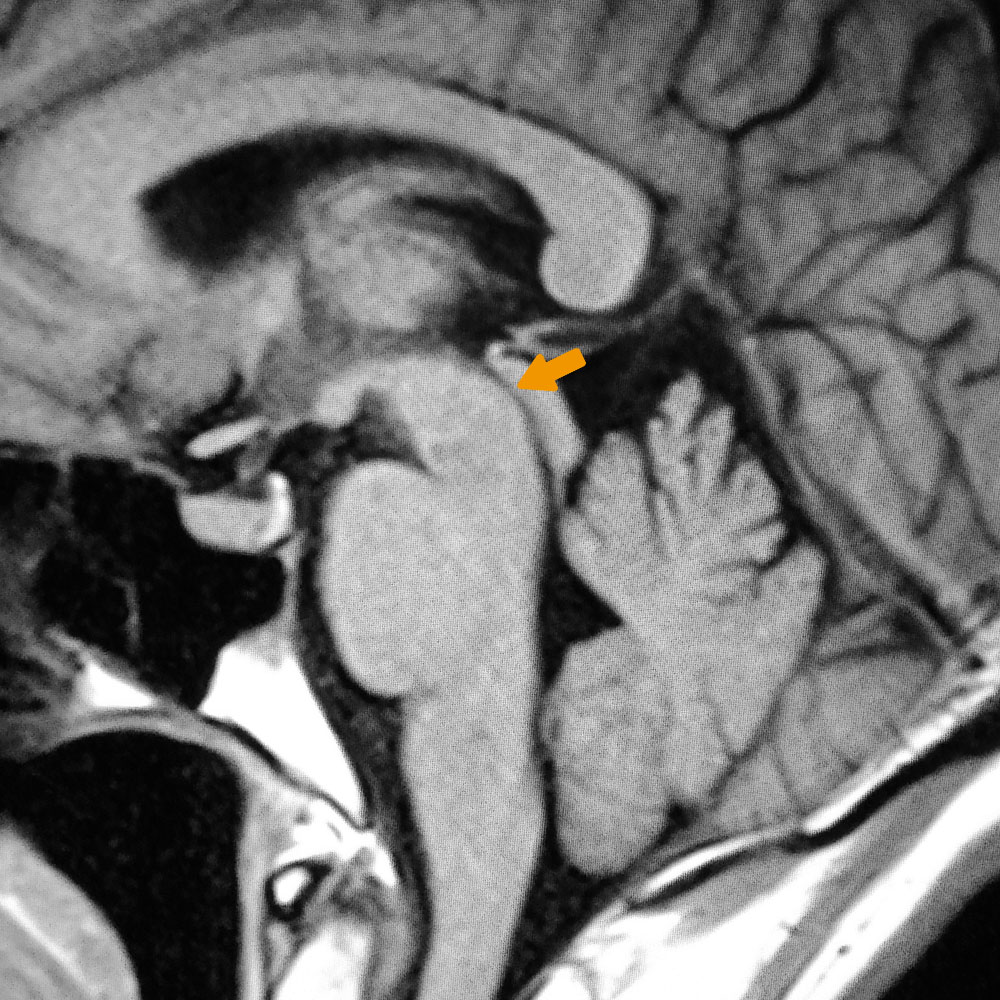 図1 パーキンソン病のMRI画像